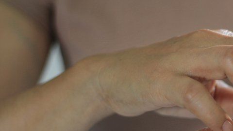 Las personas que tienen dermatilomanía pueden pellizcar o rascar lunares, pecas, marcas o cicatrices para "suavizarlos" o "perfeccionarlos".