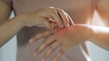 Las personas que tienen dermatilomanía pueden pellizcar o rascar lunares, pecas, marcas o cicatrices para "suavizarlos" o "perfeccionarlos".