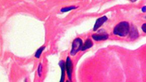 La nueva técnica podría matar una amplia gama de células cancerosas, incluidas las de mama y próstata.