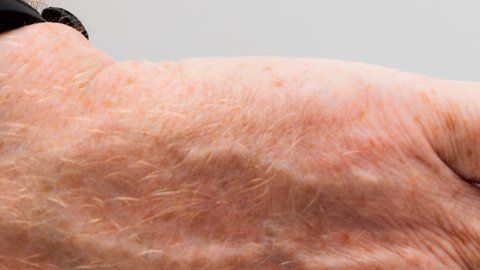 La septicemia es causada cuando el sistema inmune entra en colapso y, en lugar de combatir una infección, también comienza a atacar otras partes del cuerpo.