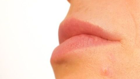 acne-Kjerstin Michaela Haraldsen en Pixabay