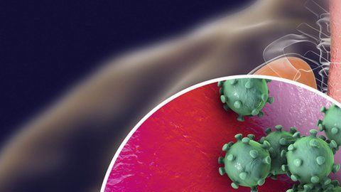 El coronavirus puede causar lesiones severas en los pulmones.