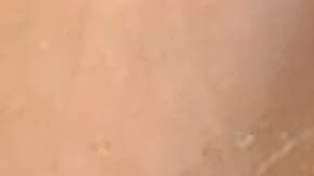 El joven tuvo que recibir atención médica por las quemaduras.