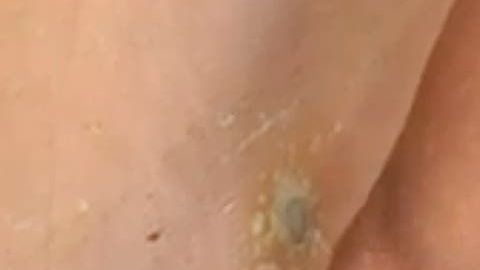 El joven tuvo que recibir atención médica por las quemaduras.