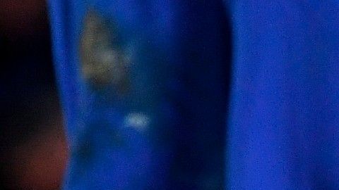 Lewandowski deberá estar enyesado durante diez días y luego iniciar la rehabilitación.