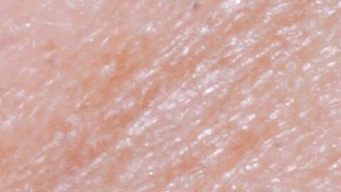 Un problema hormonal provoca esta extraña condición.