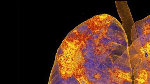 Una imagen que los doctores no quisieran ver: la de pulmones infectados con coronavirus.