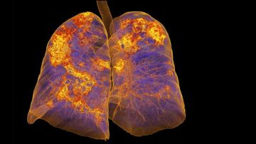 Una imagen que los doctores no quisieran ver: la de pulmones infectados con coronavirus.
