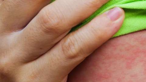 Casos de sarampión.