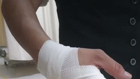 Sandra Alemán Arellano mostró sus dedos fracturados.