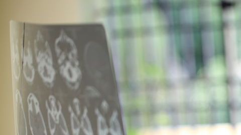 Doctora revisando tomografía cerebral