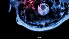 Investigan relación de derrames cerebrales con COVID-19.
