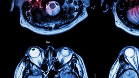 Investigan relación de derrames cerebrales con COVID-19.