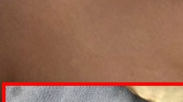 El implante salvó a la mujer.