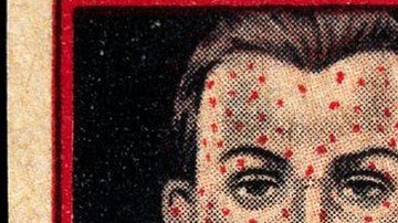 97087793_-left_face_of_a_man_suffering_from_smallpox_-right_vaccin_wellcome_l0027419