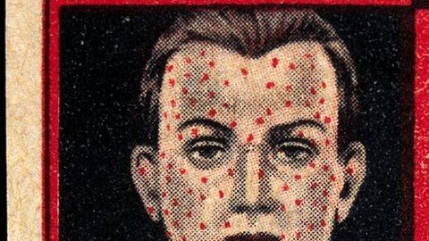 97087793_-left_face_of_a_man_suffering_from_smallpox_-right_vaccin_wellcome_l0027419