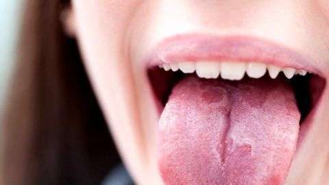 La afección suele cambiar de forma y de ubicación.