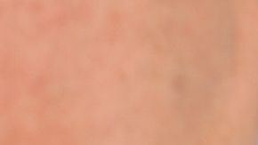 Dicho malestar lo tuvo una joven italiana que dio positivo a covid-19.