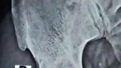 El paciente acudió con dolor porque se había insertado un cable por el pene.
