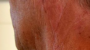 El hombre estuvo más de dos meses internado.