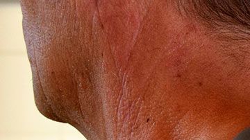 El hombre estuvo más de dos meses internado.