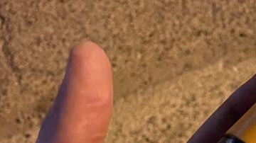 Heridas por las pelotas de goma que lanzan los policías a los manifestantes.