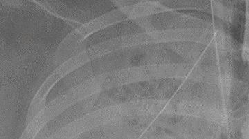 El daño en los pulmones era irreversible.