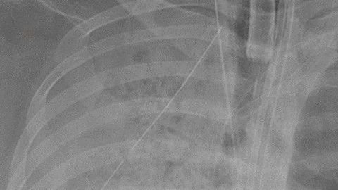 El daño en los pulmones era irreversible.