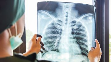 pulmones radiografía