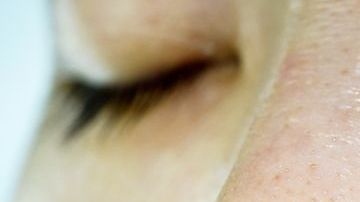 La leche de vaca puede estar relacionada con un aumento de los brotes de acné.