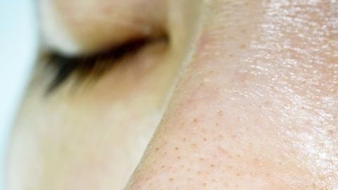 La leche de vaca puede estar relacionada con un aumento de los brotes de acné.