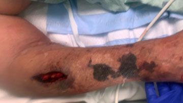 Los médicos dicen que con este hallazgo pueden ser más agresivos para tratar el coronavirus.