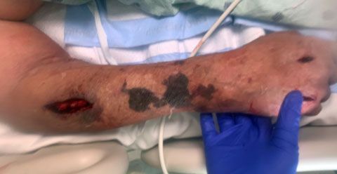 Los médicos dicen que con este hallazgo pueden ser más agresivos para tratar el coronavirus.