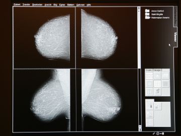 Imágenes digitales de un estudio de mamografía, técnica usada para detectar cáncer de mama.