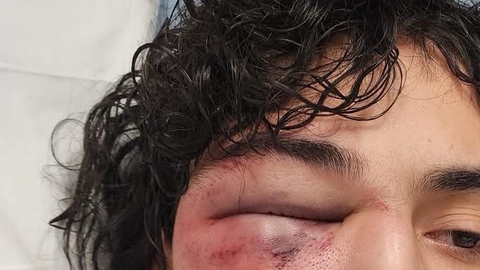 El joven “J.R.” muestra las lesiones en su rostro que, alega una demanda, sufrió a manos de policías de Rockford, IL. (Cortesía Loevy+Loevy)